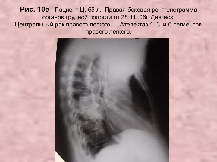 Н.С. Воротынцева. С.С. Гольев Рентгенопульмонология Рис. 10е . Пациент Ц. 65 л. Правая