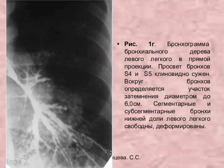 Н.С. Воротынцева. С.С. Гольев Рентгенопульмонология Рис. 1г. Бронхограмма бронхиального дерева