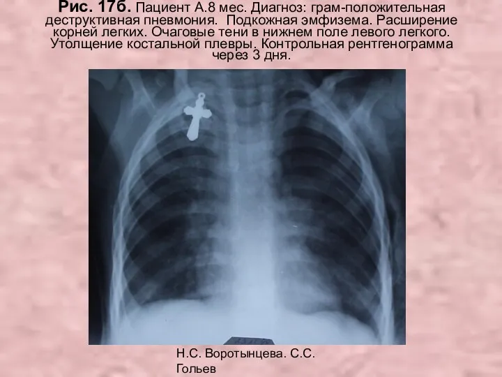 Н.С. Воротынцева. С.С. Гольев Рентгенопульмонология Рис. 17б. Пациент А.8 мес. Диагноз: грам-положительная деструктивная