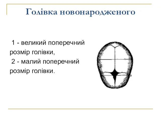 Голівка новонародженого 1 - великий поперечний розмір голівки, 2 - малий поперечний розмір голівки.