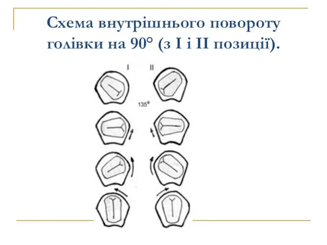 Схема внутрішнього повороту голівки на 90° (з І і II позиції).