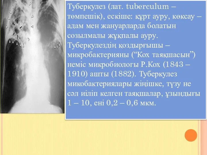 Туберкулез (лат. tuberculum – төмпешік), ескіше: құрт ауру, көксау –