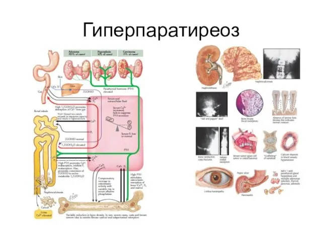 Гиперпаратиреоз