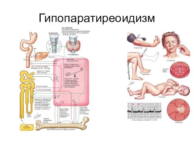 Гипопаратиреоидизм