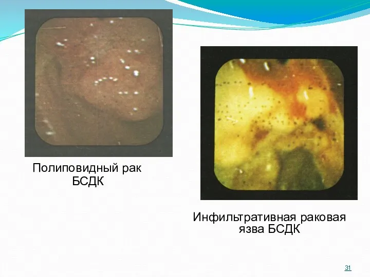 Полиповидный рак БСДК Инфильтративная раковая язва БСДК