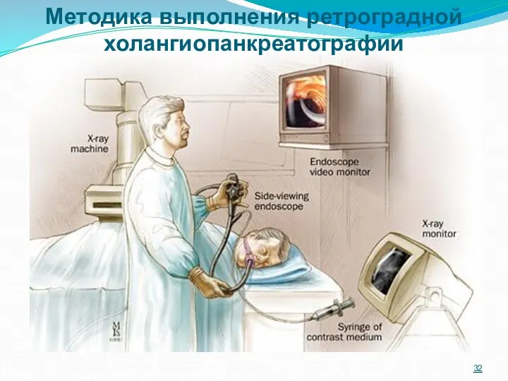 Методика выполнения ретроградной холангиопанкреатографии