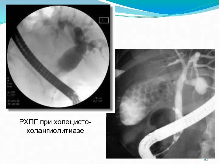 РХПГ при холецисто-холангиолитиазе