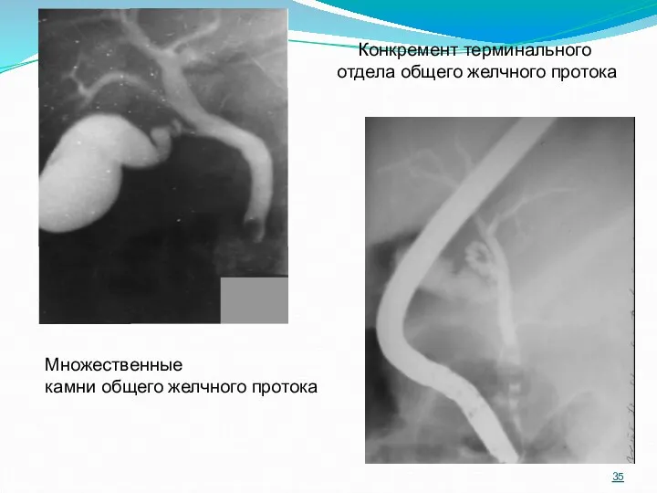 Конкремент терминального отдела общего желчного протока Множественные камни общего желчного протока