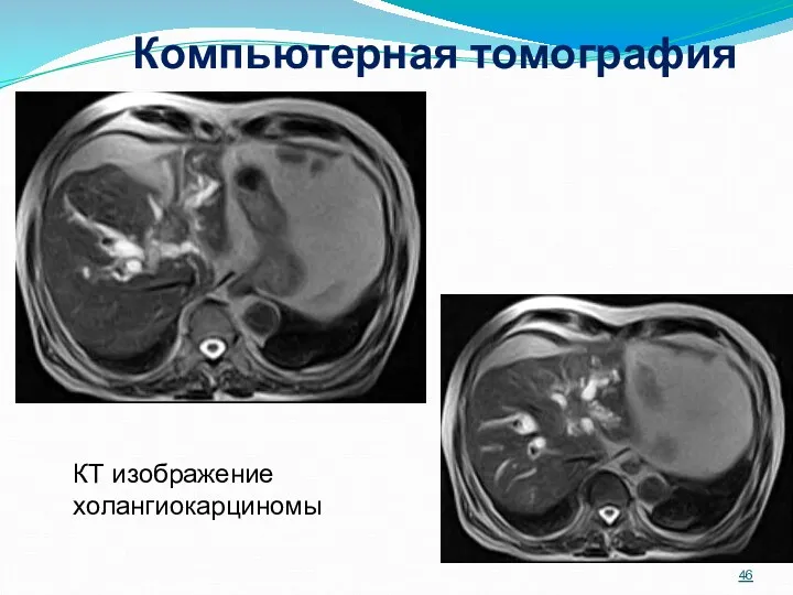 Компьютерная томография КТ изображение холангиокарциномы