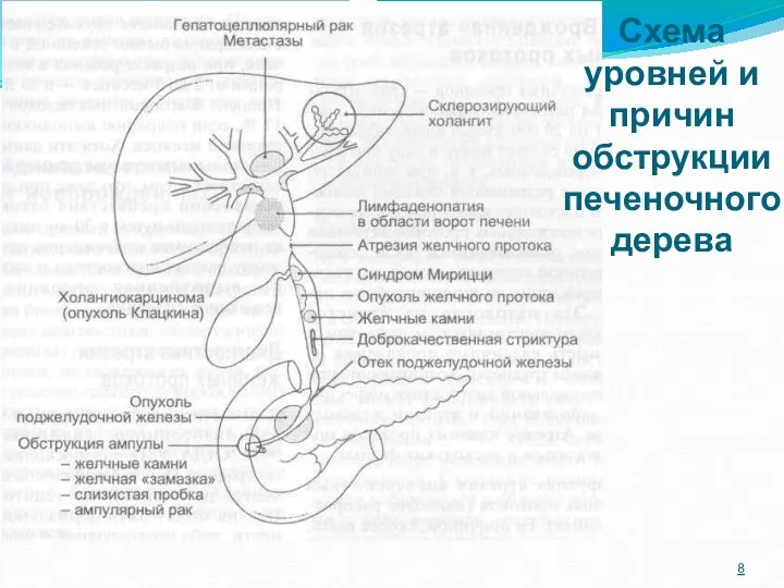 Схема уровней и причин обструкции печеночного дерева