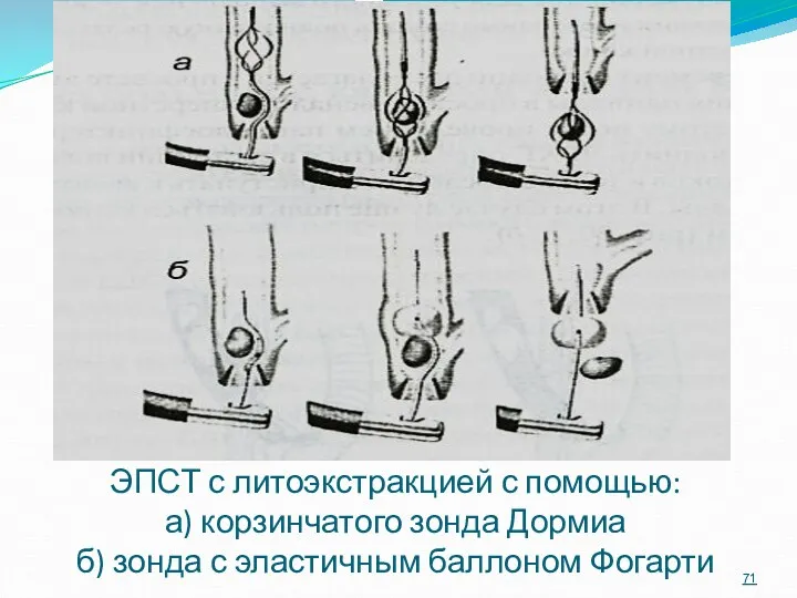 ЭПСТ с литоэкстракцией с помощью: а) корзинчатого зонда Дормиа б) зонда с эластичным баллоном Фогарти