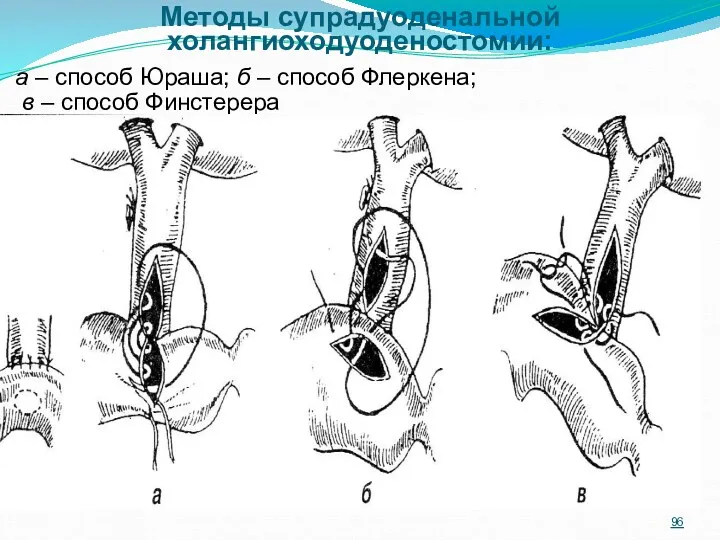 Методы супрадуоденальной холангиоходуоденостомии: а – способ Юраша; б – способ Флеркена; в – способ Финстерера