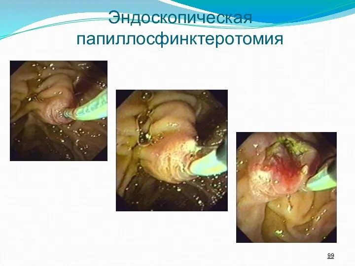 Эндоскопическая папиллосфинктеротомия