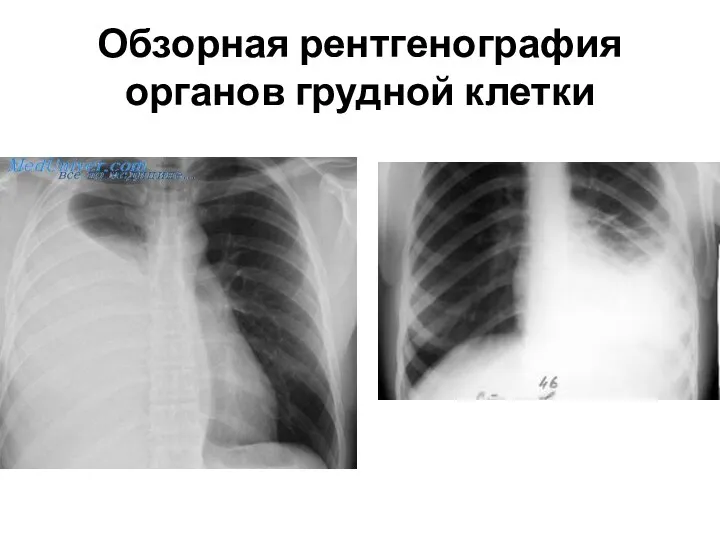 Обзорная рентгенография органов грудной клетки