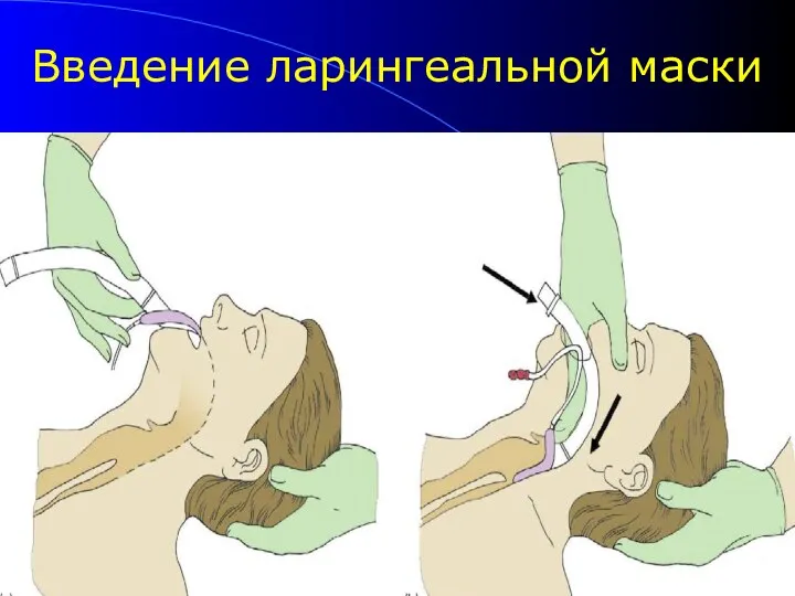 Введение ларингеальной маски