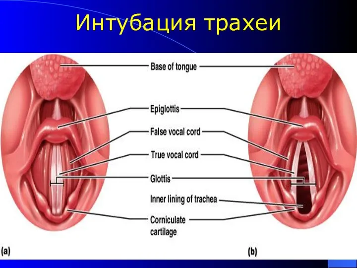 Интубация трахеи