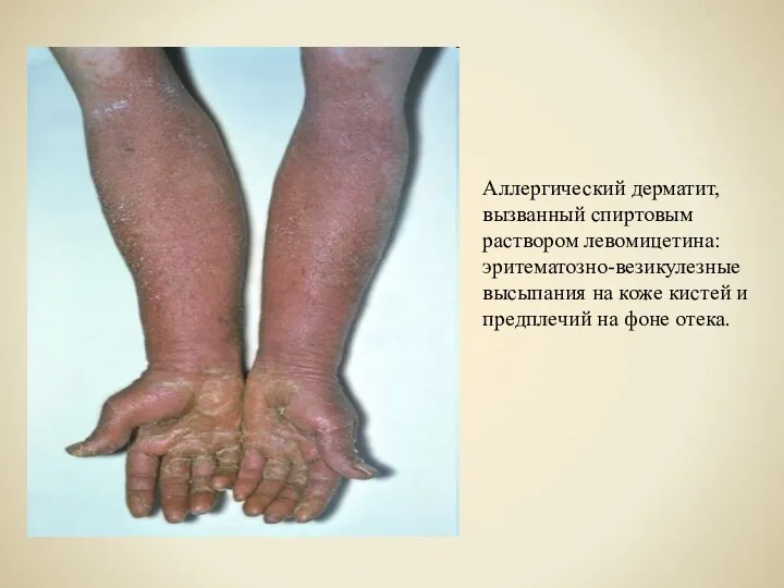 Аллергический дерматит, вызванный спиртовым раствором левомицетина: эритематозно-везикулезные высыпания на коже кистей и предплечий на фоне отека.