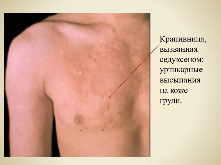 Крапивница, вызванная седуксеном: уртикарные высыпания на коже груди.