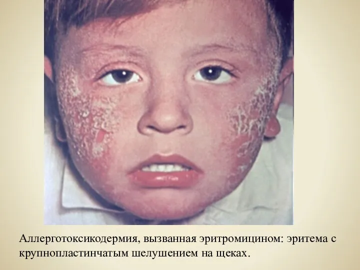 Аллерготоксикодермия, вызванная эритромицином: эритема с крупнопластинчатым шелушением на щеках.