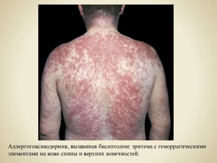 Аллерготоксикодермия, вызванная бисептолом: эритема с геморрагическими элементами на коже спины и верхних конечностей.
