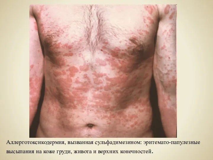 Аллерготоксикодермия, вызванная сульфадимезином: эритемато-папулезные высыпания на коже груди, живота и верхних конечностей.
