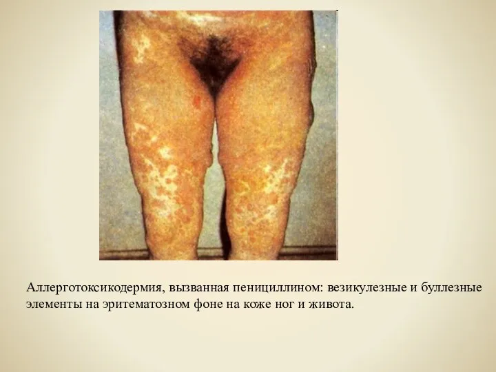 Аллерготоксикодермия, вызванная пенициллином: везикулезные и буллезные элементы на эритематозном фоне на коже ног и живота.