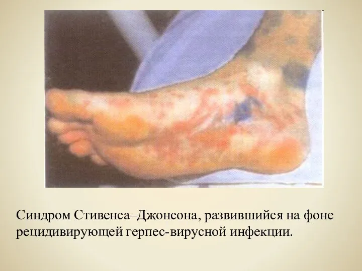 Синдром Стивенса–Джонсона, развившийся на фоне рецидивирующей герпес-вирусной инфекции.