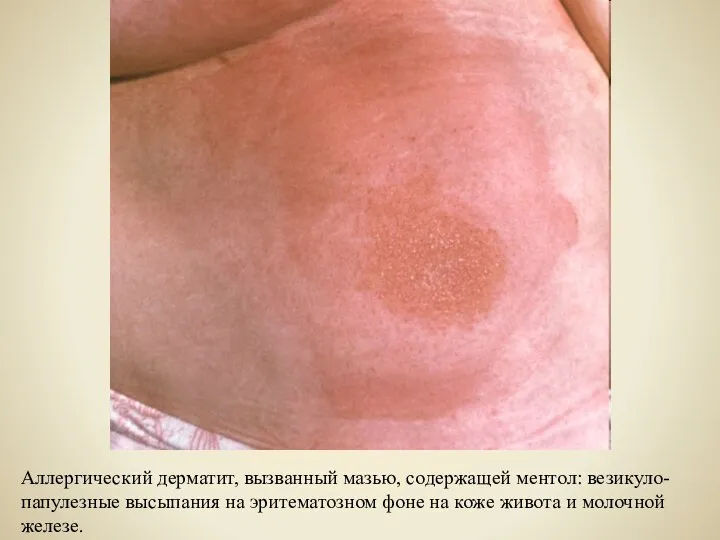 Аллергический дерматит, вызванный мазью, содержащей ментол: везикуло-папулезные высыпания на эритематозном