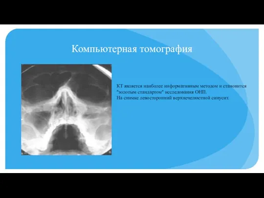 Компьютерная томография КТ является наиболее информативным методом и становится "золотым