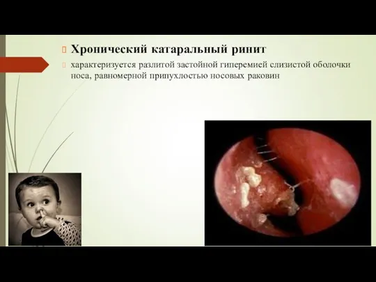 Хронический катаральный ринит характеризуется разлитой застойной гиперемией слизистой оболочки носа, равномерной припухлостью носовых раковин