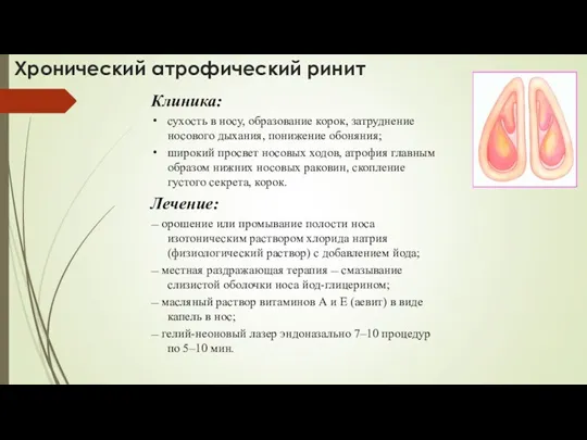 Хронический атрофический ринит Клиника: сухость в носу, образование корок, затруднение