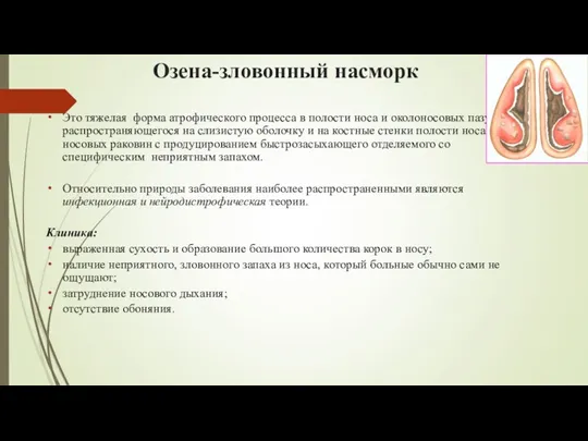 Озена-зловонный насморк Это тяжелая форма атрофического процесса в полости носа