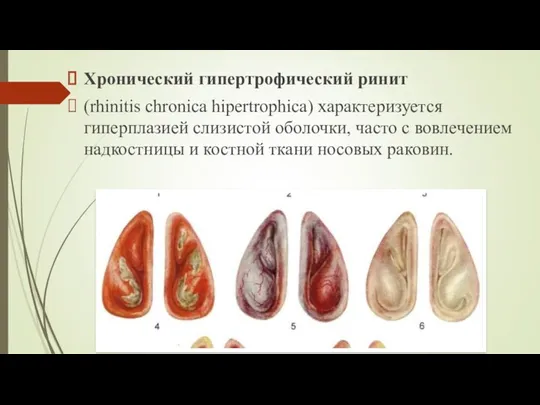 Хронический гипертрофический ринит (rhinitis chronica hipertrophica) характеризуется гиперплазией слизистой оболочки,