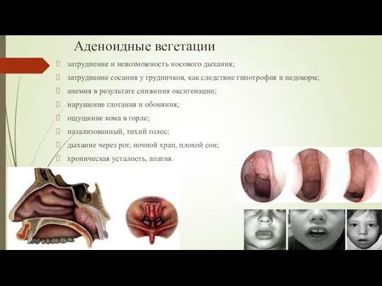 Аденоидные вегетации затруднение и невозможность носового дыхания; затруднение сосания у