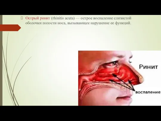 Острый ринит (rhinitis acuta) — острое воспаление слизистой оболочки полости носа, вызывающее нарушение ее функций.