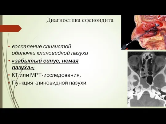 Диагностика сфеноидита воспаление слизистой оболочки клиновидной пазухи «забытый синус, немая