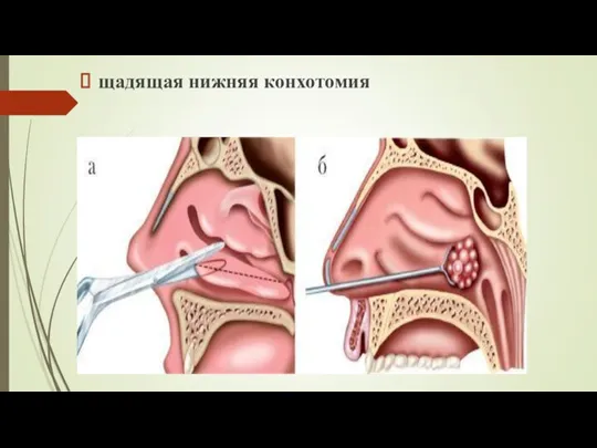 щадящая нижняя конхотомия
