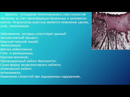 Акантоз - утолщение эпителиального слоя слизистой оболочки за счет пролиферации