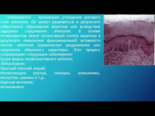 Гиперкератоз - чрезмерное утолщение рогового слоя эпителия. Он может развиваться