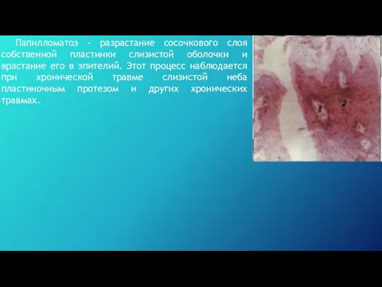 Папилломатоз - разрастание сосочкового слоя собственной пластинки слизистой оболочки и