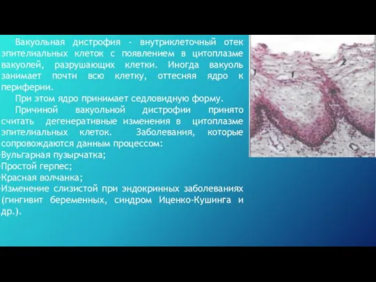 Вакуольная дистрофия - внутриклеточный отек эпителиальных клеток с появлением в