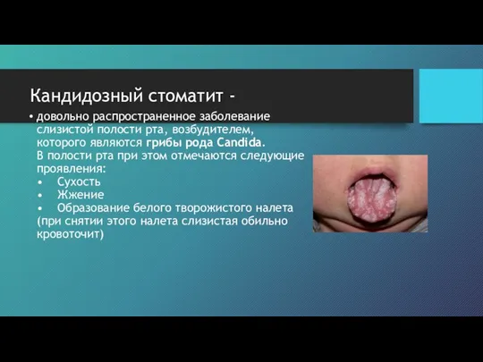 Кандидозный стоматит - довольно распространенное заболевание слизистой полости рта, возбудителем,