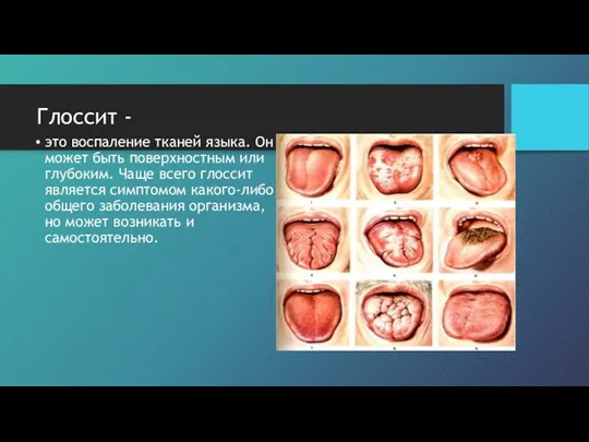 Глоссит - это воспаление тканей языка. Он может быть поверхностным