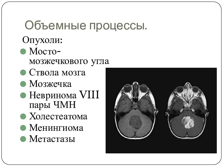 Объемные процессы. Опухоли: Мосто-мозжечкового угла Ствола мозга Мозжечка Невринома VIII пары ЧМН Холестеатома Менингиома Метастазы