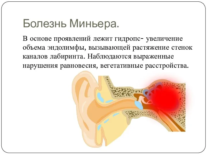 Болезнь Миньера. В основе проявлений лежит гидропс- увеличение объема эндолимфы, вызывающей растяжение стенок