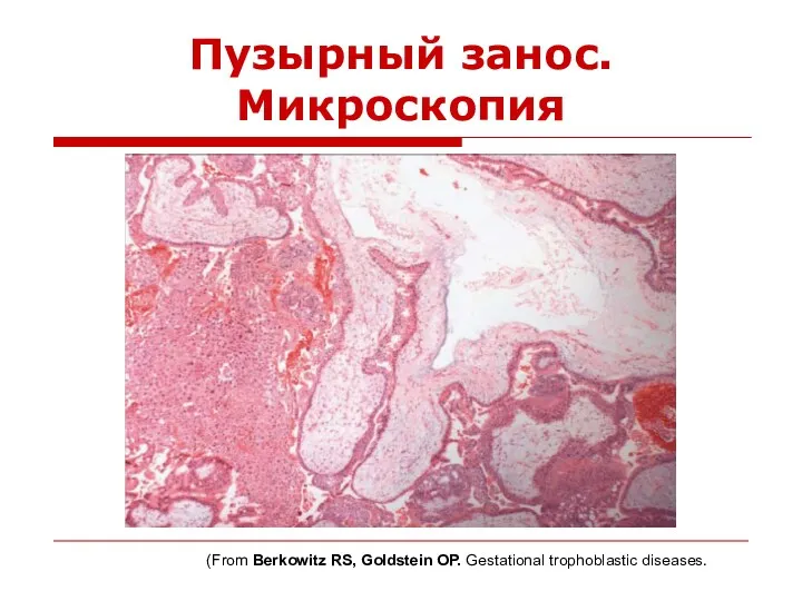 Пузырный занос. Микроскопия (From Berkowitz RS, Goldstein OP. Gestational trophoblastic diseases.