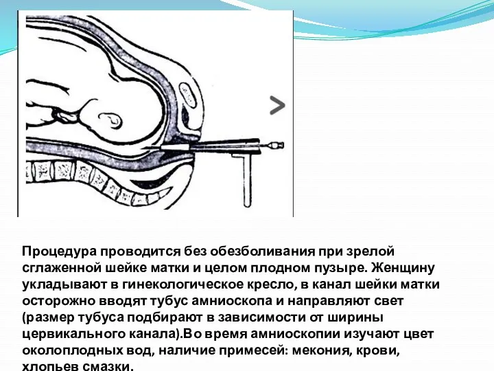 Процедура проводится без обезболивания при зрелой сглаженной шейке матки и