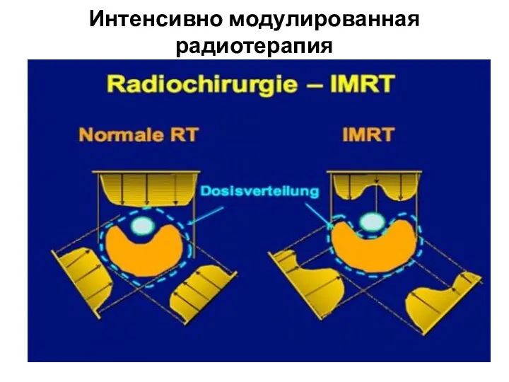Интенсивно модулированная радиотерапия