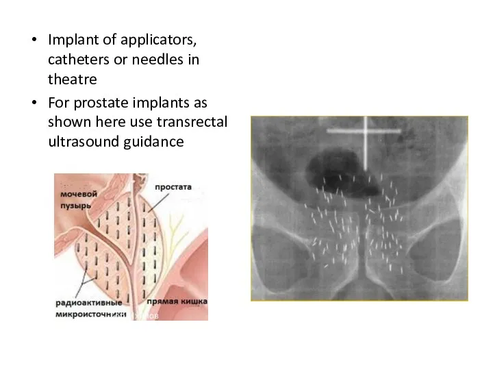 Implant of applicators, catheters or needles in theatre For prostate