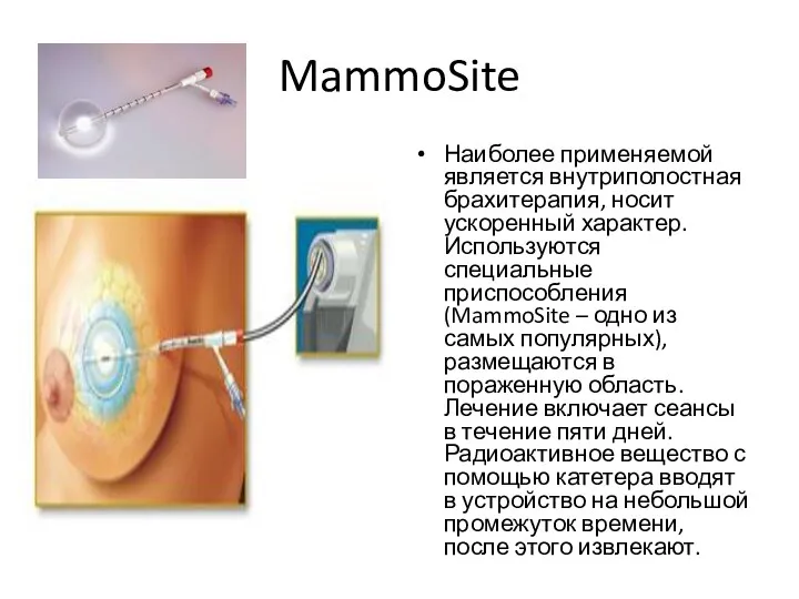 MammoSite Наиболее применяемой является внутриполостная брахитерапия, носит ускоренный характер. Используются